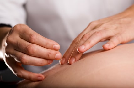 Acupuncturist at work - Indigo Massage and Wellness - Acupuncture St Louis